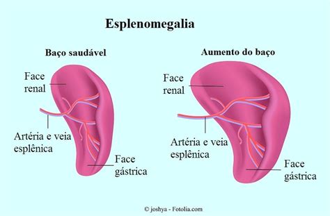 Aumento Do Ba O Ou Esplenomegalia Causas Sintomas Ou Tratamento