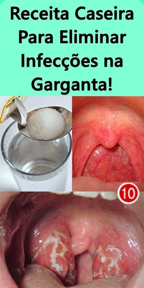 Como Eliminar Caseum Na Garganta - Receita Caseira Para Eliminar Infecções na Garganta! | Remédios para ...