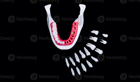 Tooth implant and crown installation process 11257192 Stock Photo at ...