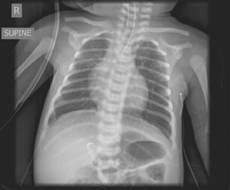 Tracheoesophageal Fistula X Ray