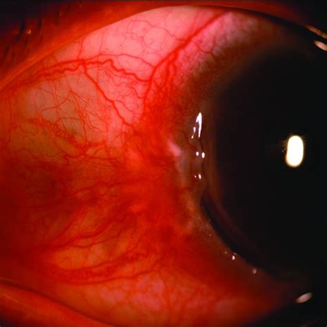 Slit Lamp Photograph Of A 42 Year Old Male Showing Anterior Scleritis