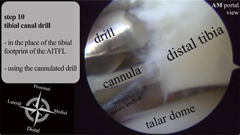 Stabilization Of Anterior Aspect Of Distal Tibiofibular Syndesmosis A