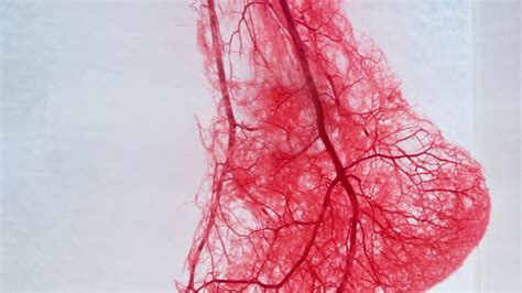 vascular disease | University of Utah Health | University of Utah Health