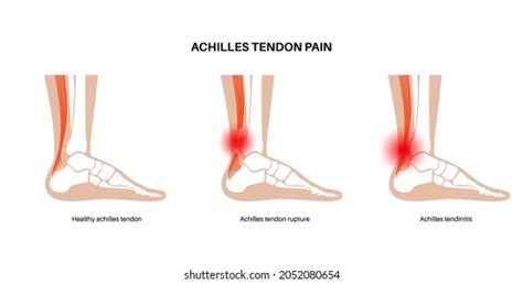 Achilles Tendon Rupture Treatment Therapies And Recovery 47 OFF