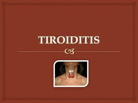 Tiroiditis Causas Tipos Y Tratamiento Ppt