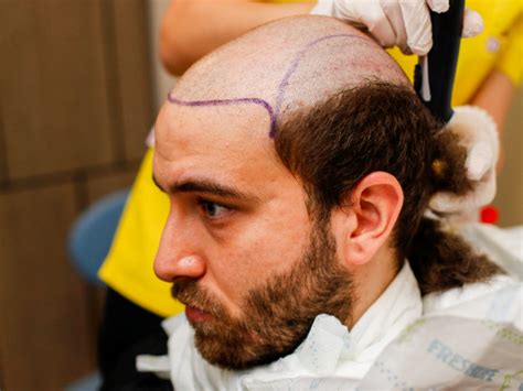 Sapphire Fue Hair Transplant Dr Fatih Köroğlu