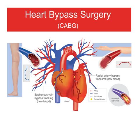 What Is Triple Heart Bypass Surgery At Henrytmcclure Blog