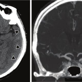 Computed Tomography CT Scans Showing Acute Subdural Hematoma