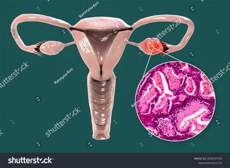 Ovarian Cancer 3d Illustration Showing Malignant Stock Illustration