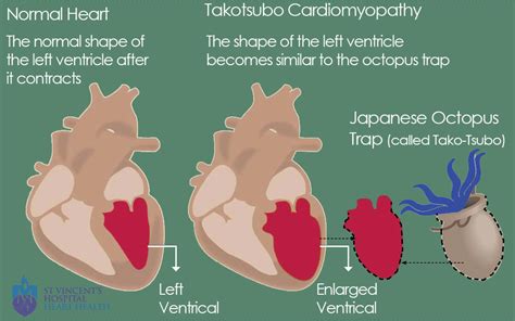 Takotsubo Cardiomyopathy Potential Trigger By COVID 19 Vaccines A