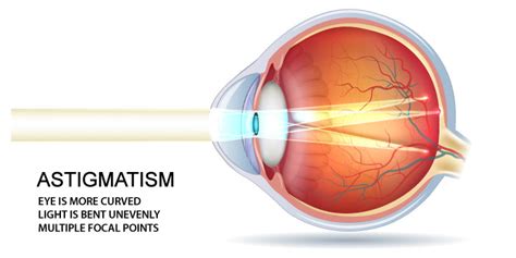 Astigmatism Symptoms Causes And Treatment Fyeyes