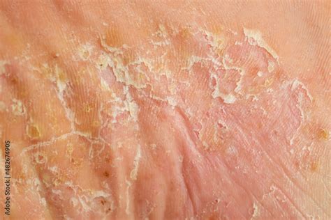 Pustular Psoriasis On Feet Pictures Symptoms And Pictures Hot Sex Picture