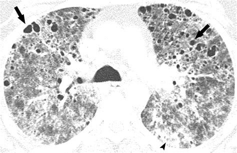 Pneumocystis Jiroveci Pneumonia High Resolution Ct Findings In Patients With And Without Hiv