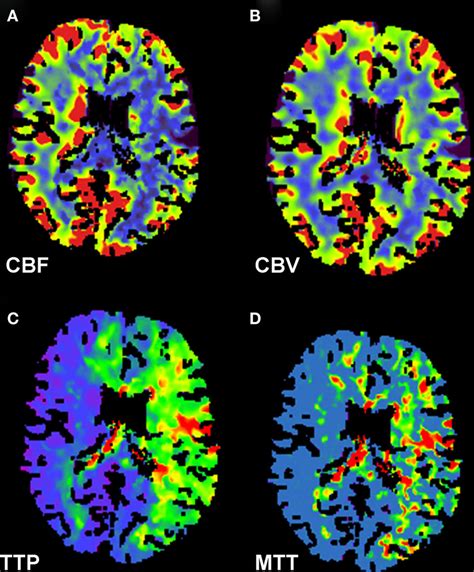 Brain Death Perfusion Scan