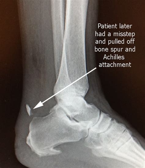 Achilles Tendonitis Drwolgin