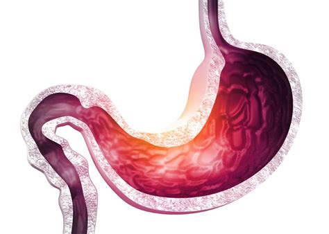 chronic gastritis     treated thrive gi