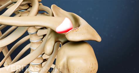 Acromioclavicular Arthritis Symptoms