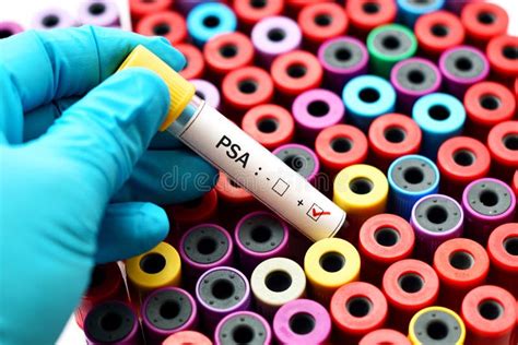 PSA Positive Blood Sample Stock Image Image Of Scientific 111498141