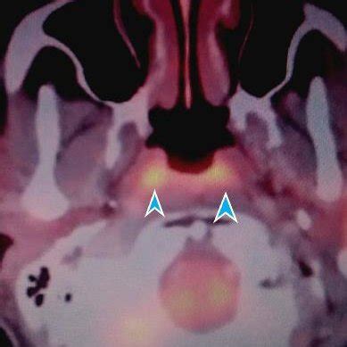 (PDF) 'Tubarial Glands' and Minor Salivary Glands - Anatomy, Physiology ...