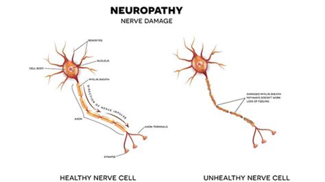 Peripheral Neuropathy Zao Rehab