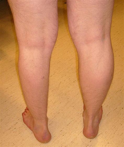 Treating Body Asymmetry With Postural Restoration Simio Physical Therapy
