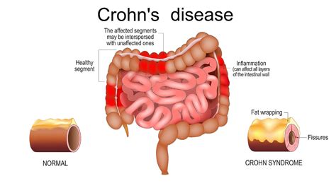 Living With Crohns Disease Symptoms And Treatment Solve Any Issue