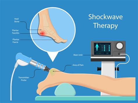 Eswt Treatment For Achilles Tendonitis Treatment Is Eswt Worth It