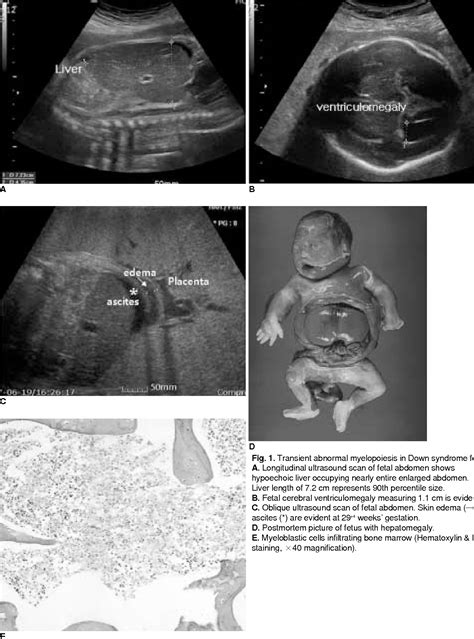 21 Week Ultrasound Down Syndrome