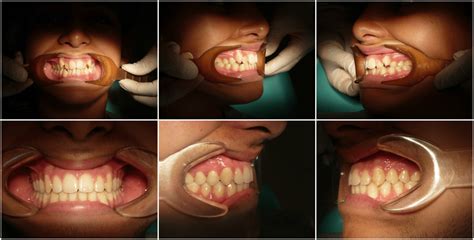 Maloclusión Dental ¿necesitas Ortodoncia Clínica Ortodent Tenerife