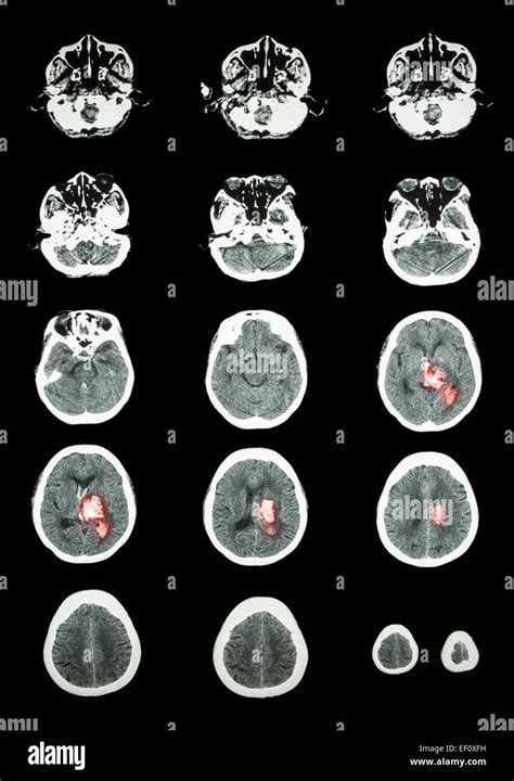 Accidente Cerebrovascular Hemorrágico Tomografía Computarizada Tac