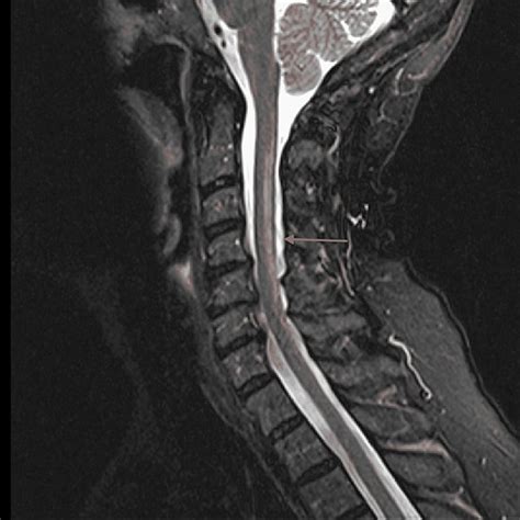 MRI cervical spine, Sagittal T2 view showing hyperintensity along with... | Download Scientific ...