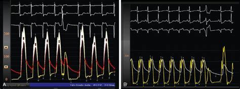 Aortic Stenosis Clinical Presentation Disease Stages And Timing Of