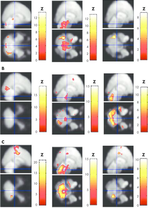 Functional Magnetic Resonance Imaging Findings Of Normal Volunteers And