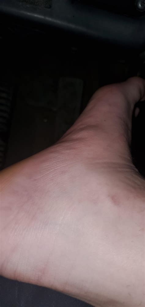 Itchy Bump On Foot Arch Sale Online Emergencydentistry