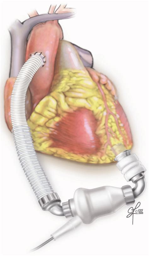 Illustration Of Heart Mate Ii Thoratec Pleasanton Ca Usa