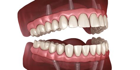 Full Mouth Reconstruction A Comprehensive Guide Full Arch Clinic