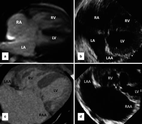 Atrioventricular Septal Defects Radiology Key