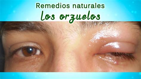 Orzuelos En Los Ojos Remedios Naturales Para Eliminar Un Orzuelo