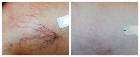 Laser Vein Removal Spider Veins Dermacare Cosmetic And Laser Clinic Melbourne