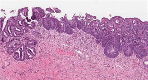 high grade squamous intraepithelial lesion Archives | Atlas of Pathology