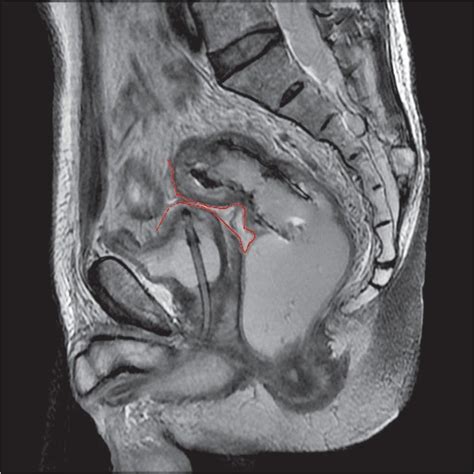 Sagittal View Of The Peritoneal Reflection Red Line By Rectal Mri Download Scientific Diagram