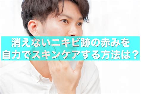 男の消えないニキビ跡の赤みを自力でスキンケアする方法は？ 身だしなみトトノエブログ～スキンケアから髭や体毛のことまで