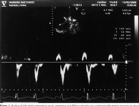 Figure 1 From Left Atrial Appendage Function In Patients With Mitral