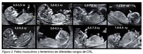 Para Las Que Se Isieron La Eco De 12 O 13 Semanas El Tuberculo Genital