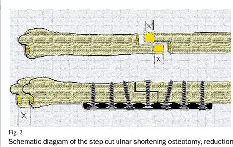 Figure From Free Medial Femoral Condyle Flap For Reconstruction Of