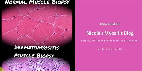 Nicholes Myositis Blog Myositis Support And Understanding