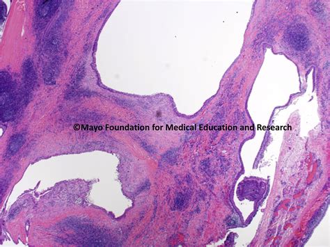 Branchial Cleft Cyst Histology