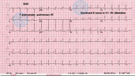 The ECG’s of Pulmonary Embolism | Resus