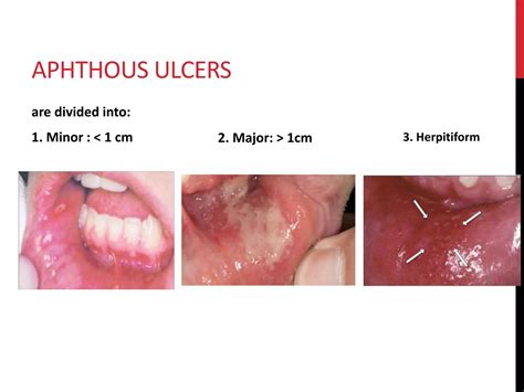 Oral Manifestations Of Systemic Disease Ppt