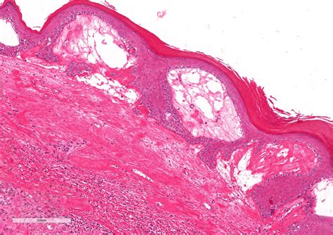 Balanitis Xerotica Obliterans Histology